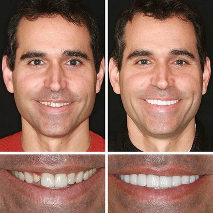 🏆Ends Today: Exclusive Smile Care Offer! 🏆2026 Bestselling Product🦷 Fresh Smile Comfort, Say Goodbye to Wearing Discomfort!🌎