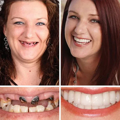 🏆Ends Today: Exclusive Smile Care Offer! 🏆2026 Bestselling Product🦷 Fresh Smile Comfort, Say Goodbye to Wearing Discomfort!🌎